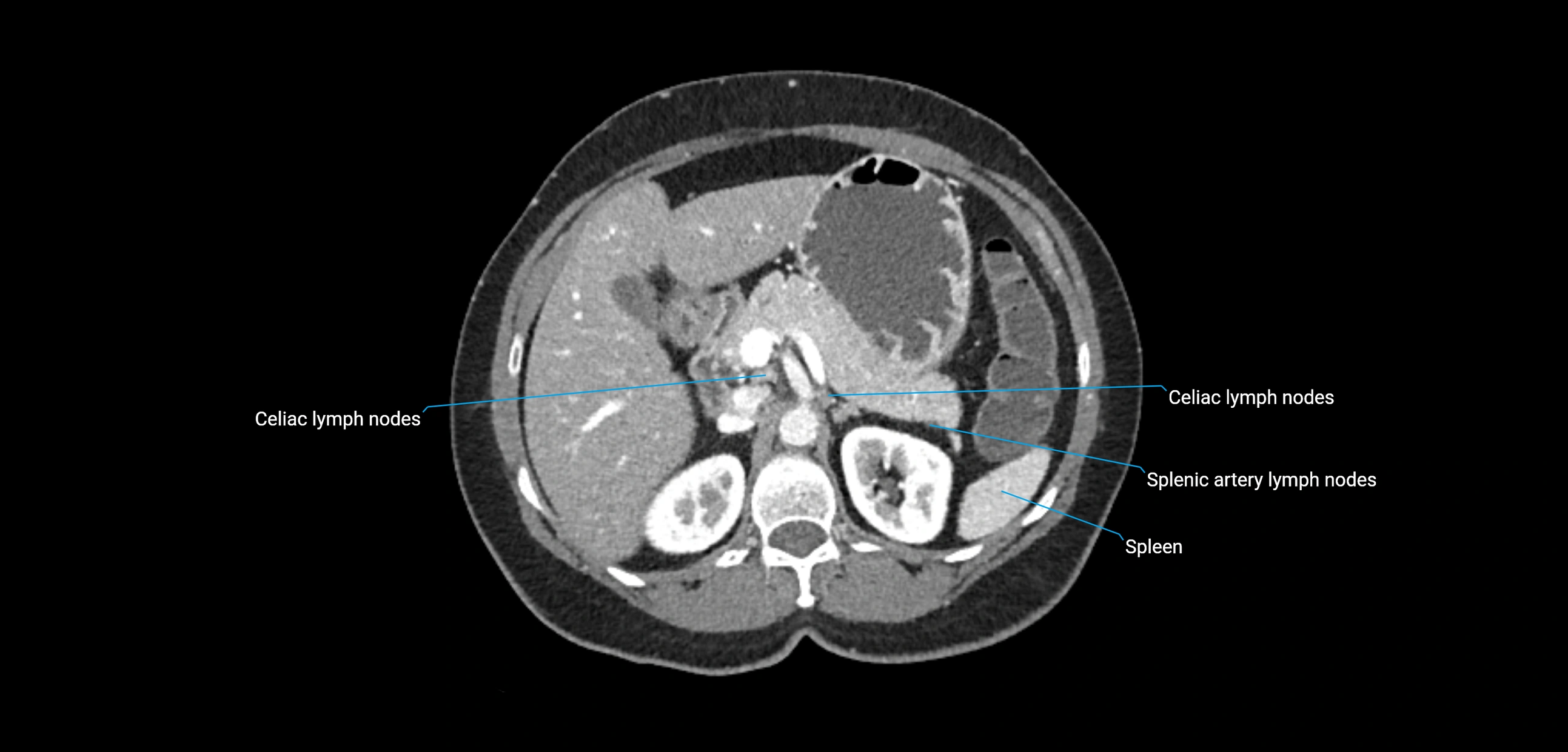 CT ct abdominal lymph nodes  axial cross sectional anatomy  enchanced radiology image -img-00002-00150.webp